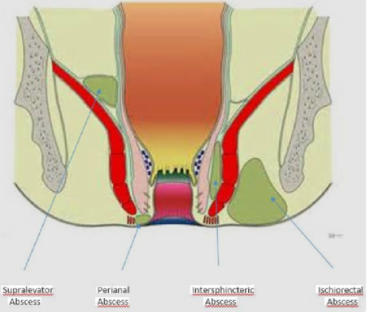 peri anal abse