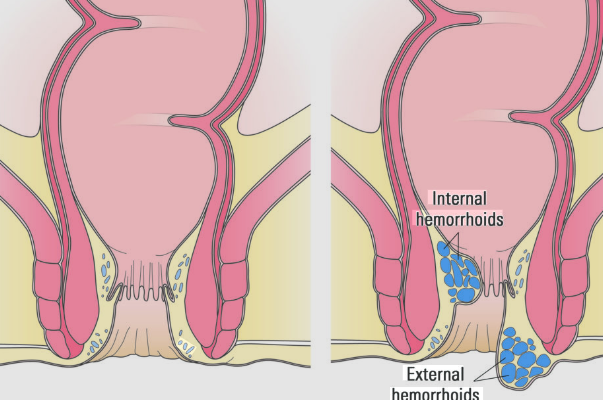 basur ya da hemoroid